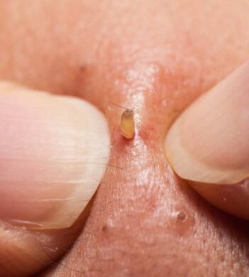 comedone extraction