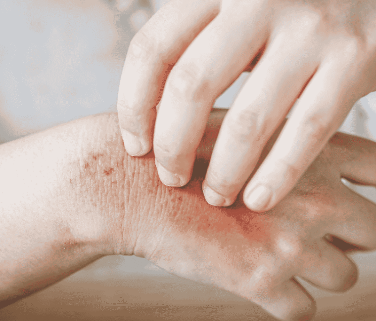 How to Treat Fungal Skin Infections Naturally