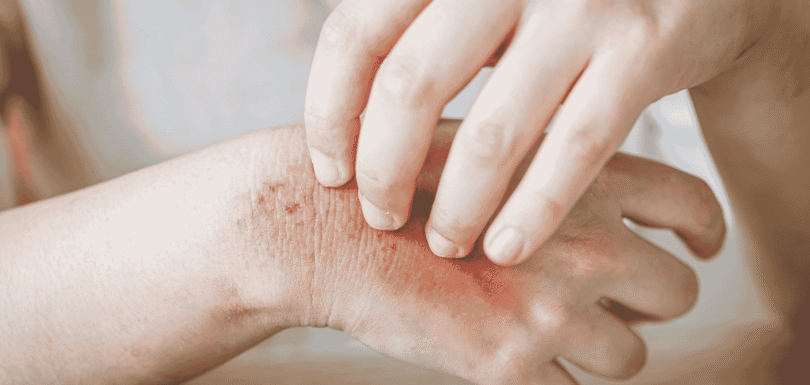 How to Treat Fungal Skin Infections Naturally