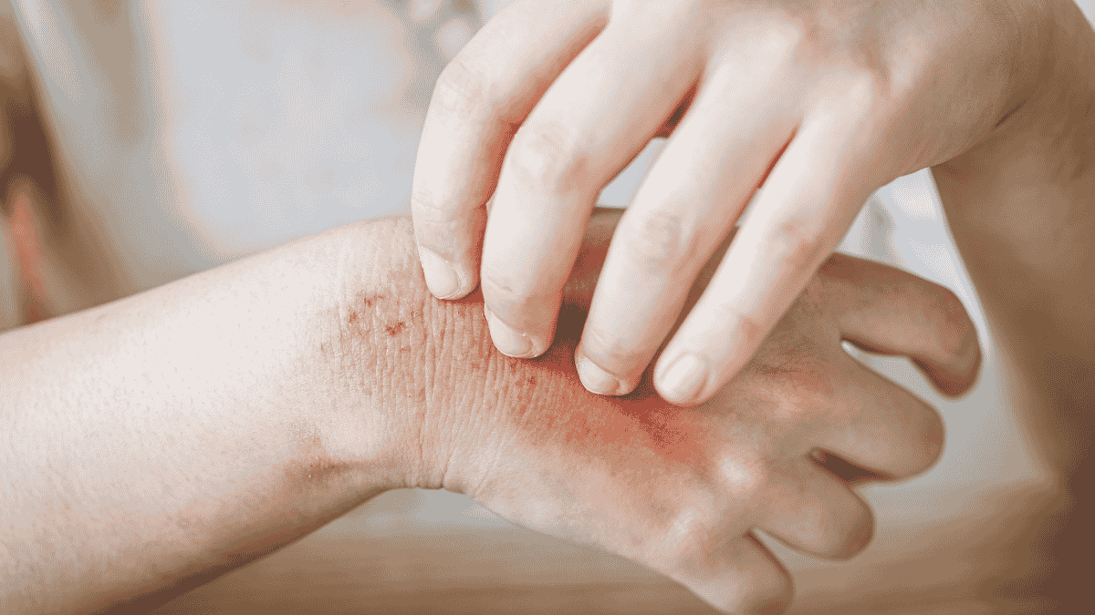 How to Treat Fungal Skin Infections Naturally