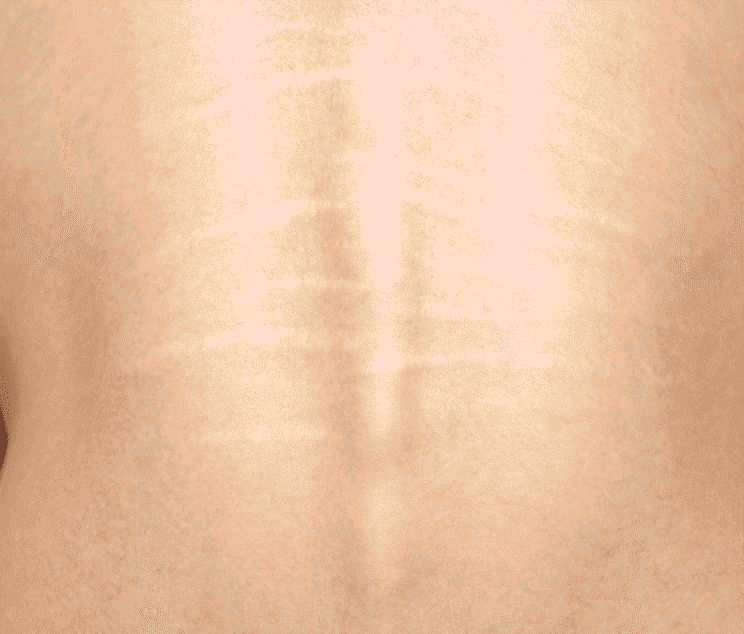 Stretch mark