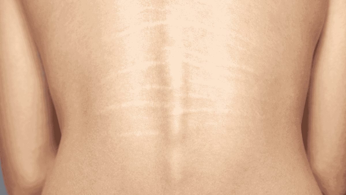 Stretch mark