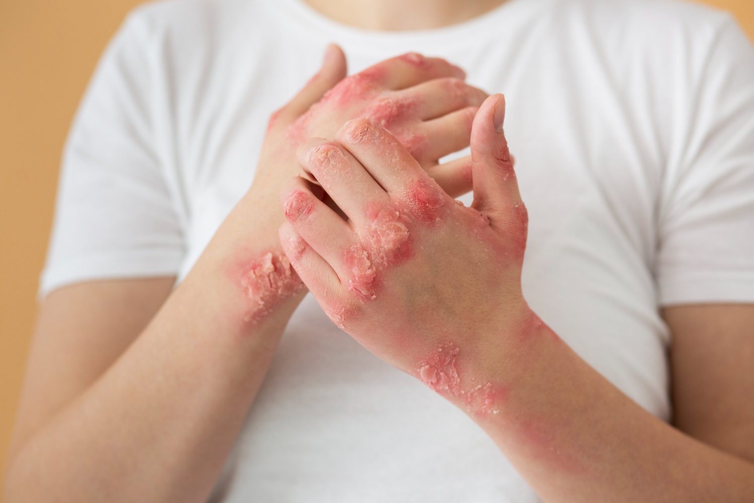 How to Treat Fungal Skin Infections Naturally