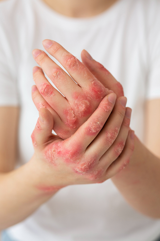 Fungal infection treatments