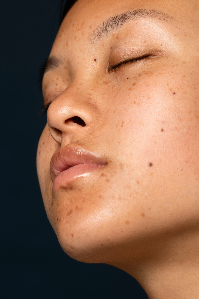 Melasma treatment