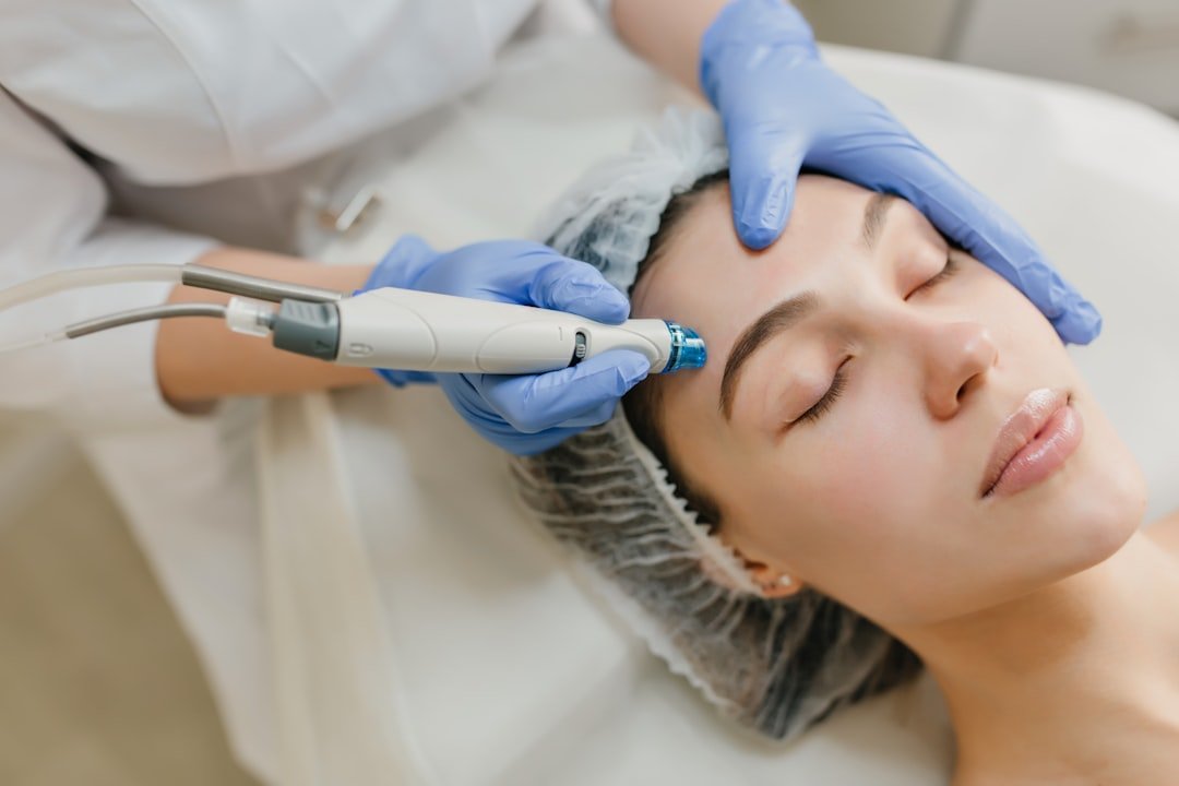 Dermatology laser treatment for acne scars