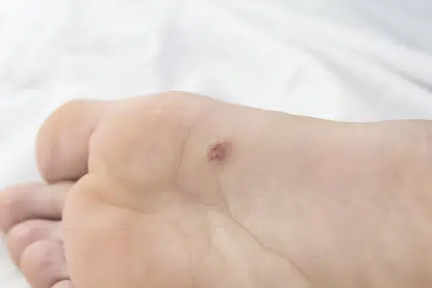 Wart removal