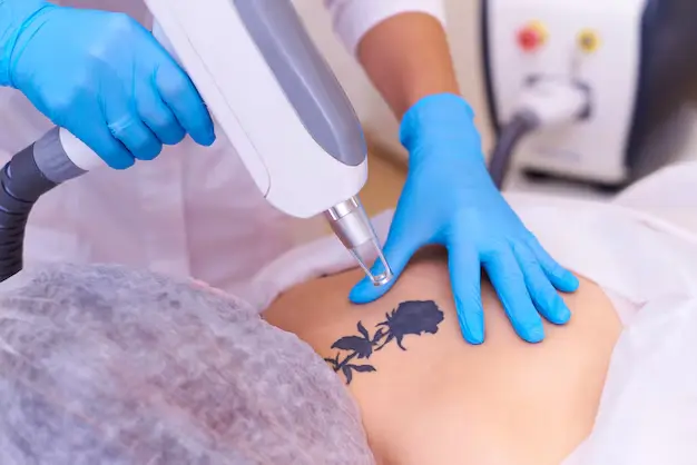 laser tattoo removal