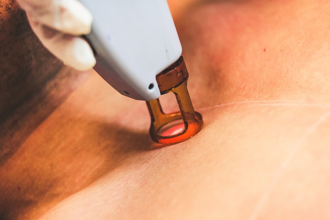 Laser device used for dermatology treatment of acne scars