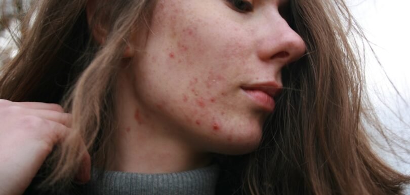 Person receiving professional dermatology treatment for skin concerns
