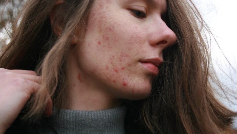 Person receiving professional dermatology treatment for skin concerns